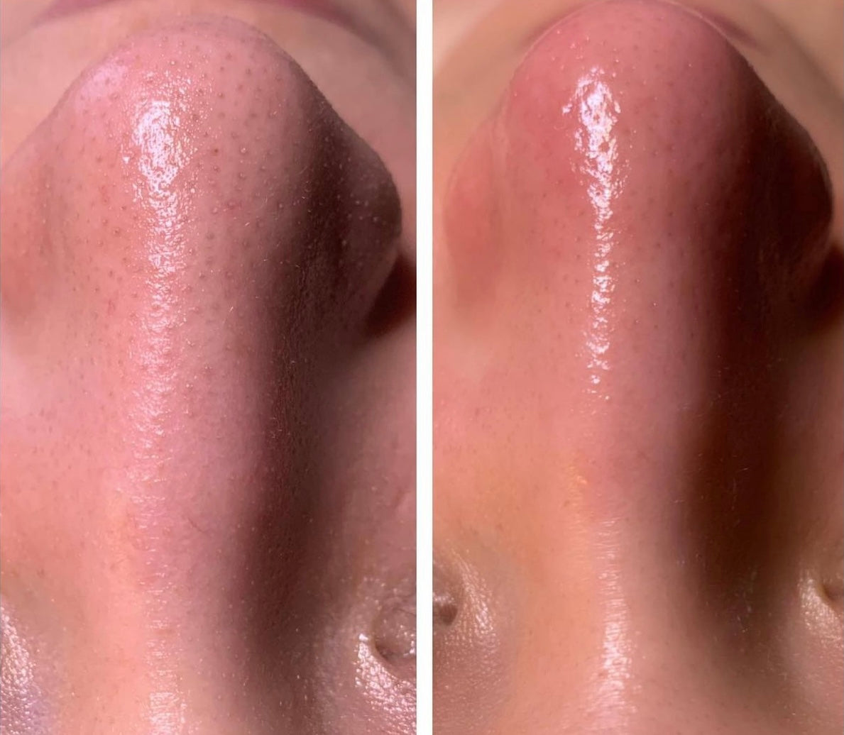 VDM Glow Microdermabrasion